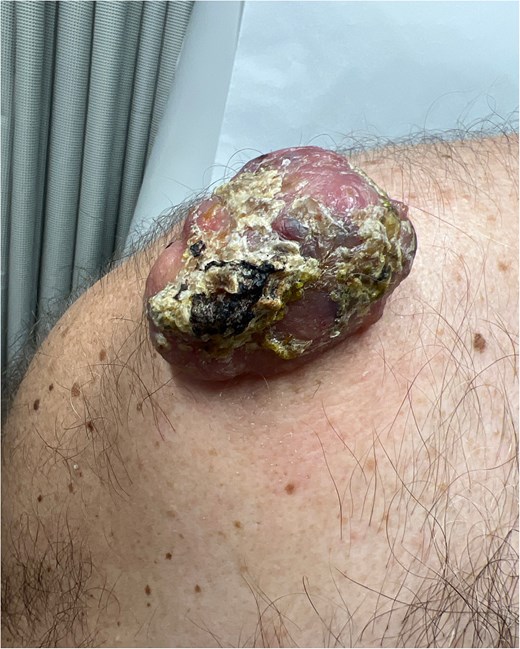 Ulcerated and lobular mass seen on right shoulder during initial consultation.