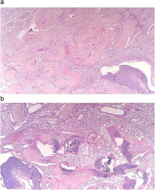 (a and b) Histopathology shows nests of central necrosis, abrupt keratinization, anucleated ghost cells, and microcalcification, consistent with a pilomatrixoma background.