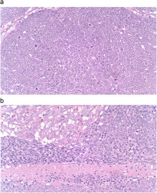 (a and b) At the periphery of the tumor, nests of basoloid and squamoid cells showed marked cytologic atypia with enlarged irregular nuclei, prominent nucleoli, increased mitotic figures, and foci of necrosis.
