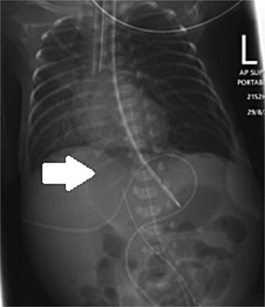 Supine and lateral decubitus abdominal X-rays on Day 11 of life showing free air (arrow), confirming intestinal perforation.