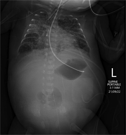 Abdominal X-ray on Day 25 demonstrating a gasless abdomen concerning for necrotic bowel.