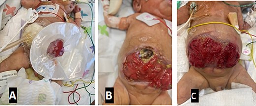 Progression of laparostomy wound and application of NPWT. Images show the evolution from initial bowel exposure to the development of a giant enteroatmospheric fistula, managed with a stoma bag and NPWT. (A) VAC + stoma bag dressing applied. (B) Four weeks post-op with a necrotic abdominal wall. (C) Wound appearance 6 months post-op.