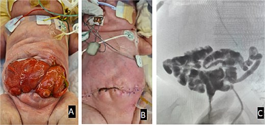 (A) Appearance of the abdomen in the immediate period pre-op. (B) Appearance of the abdomen post-op. (C) Distal loopogram shows adequate bowel length, confirming no fistula or stricture with contrast reaching the rectum.