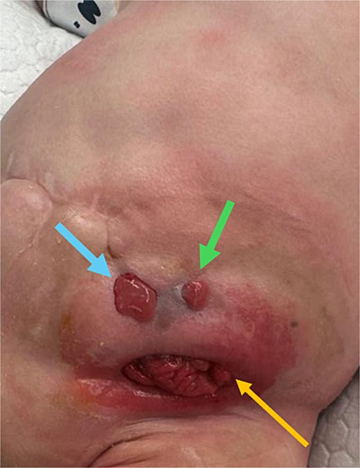 Development of new enterocutaneous fistulas after failed jejunostomy closure. Green arrow: ECF number 1. Blue arrow: ECF number 2. Yellow arrow: the new burst wound anastomosis site.