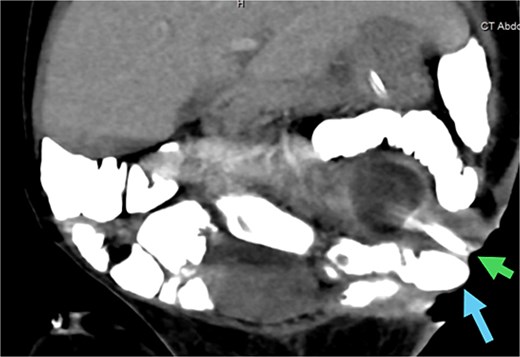 CT abdomen with oral contrast showing two enterocutaneous fistulas. Green arrow: fistula connected to the small bowel. Blue arrow: fistula connected to the proximal sigmoid colon.