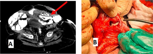 (A) CT abdomen with oral contrast showing enteroenteric fistula. The red arrow indicates a fistula between the ileum and the rectosigmoid junction. (B) Gross appearance of the enteroenteric fistula.