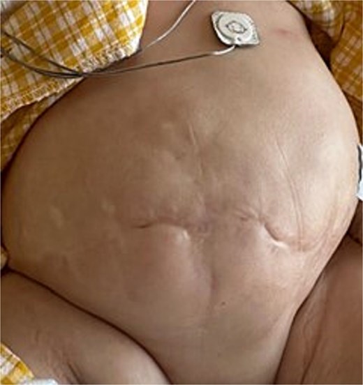 Final abdominal appearance after successful surgical closure. Direct fascial closure achieved through vertical incision; the child is shown postoperatively with intact skin coverage and healed surgical wound.