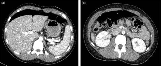 CT with intravenous contrast demonstrating large pneumoperitoneum.