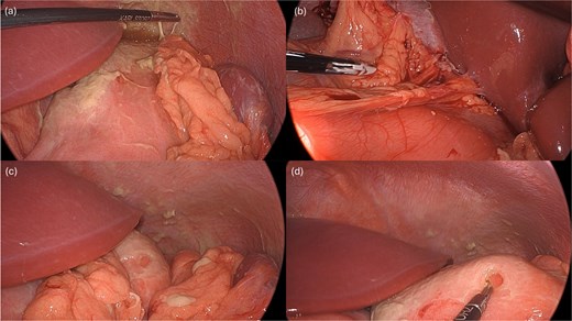 Intraoperative pictures demonstrating the sequelae of the hollow viscus perforation. The pictures in (a) and (b) demonstrate contamination and associated inflammatory adhesions in the left and right upper quadrant, respectively. The pictures in (c) and (d) demonstrate the antral perforation. The tip of the Maryland dissector was able to insert into the perforation (d) to assist with identification of the perforation endoscopically for closure.