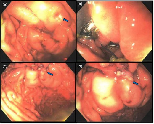 Endoscopic view of the perforation. The picture in (a) demonstrates the site of the perforation. The picture in (b) shows the use of the overstitch technique to perform the closure endoscopically. Pictures (c) and (d) demonstrate the area of perforation once the first and second layers of endoscopic closure are completed, respectively.