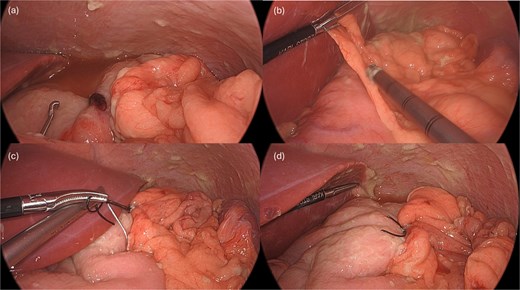 Following endoscopic closure, a leak test performed under water (a) did not demonstrate any bubbling after gastric insufflation with air. Photos (b–d) demonstrate performance of a graham patch with a redundant lip of omentum over the endoscopically closed perforation.
