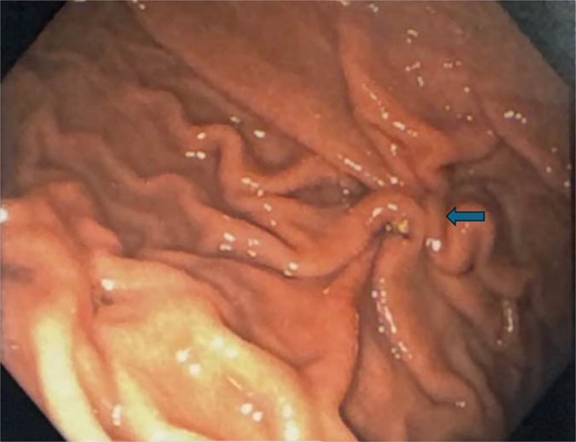 Follow-up endoscopy 3 months postoperatively demonstrating a well-healed suture line.