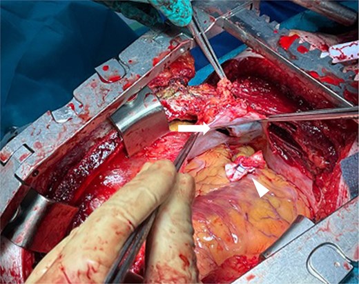 Intraoperative findings. The pruning implement had penetrated the diaphragm (arrow), resulting in right ventricular injury. Hemostasis was achieved with 3-0 polypropylene sutures reinforced with pledgets (arrowhead).
