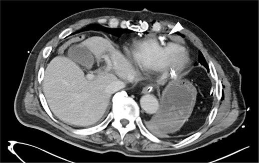 Postoperative CT findings. No evidence of pericardial effusion was observed, and the surgical site was hemostatic (arrowhead).