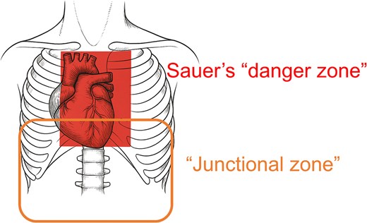 Assessment of organ injuries based on the stab wound entry site. In cases where the stab wound is located within Sauer’s danger zone, injuries to the heart or aorta should be suspected. If the entry point is in the junctional zone, transdiaphragmatic injuries must also be considered.