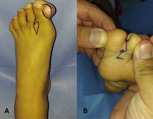 Preoperative marking in a patient with hallux duplication and syndactyly of the left foot. (A) Dorsal view of the left foot showing hallux duplication and syndactyly between the first and second toes. Preoperative markings using dermographic ink outlined the resection area for the supernumerary hallux and the design of a diamond- or rhomboid-shaped flap to aid in interdigital space reconstruction and optimize tissue adaptation. (B) Plantar view of the same case showing syndactyly between the first and second toes. A zigzag marking pattern was applied to the interdigital fusion site to reduce the formation of linear contractile scars and facilitate proper digit separation after surgery.