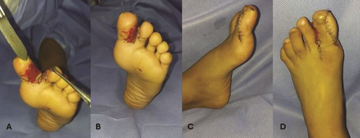 Intraoperative phases of hallux duplication and syndactyly correction of the left foot. (A) The surgical phase shows the complete removal of the supernumerary bone fragment of the left hallux and excision of the nail plate to ensure proper soft tissue approximation. Integra, an artificial dermal graft, was implanted between the first and second toes to promote tissue regeneration and reduce postoperative adhesions. (B) After the structural correction, the anatomical separation of the first and second toes was achieved, with adequate tissue coverage using the pre-designed flap. (C, D) Primary wound closure was performed with U-shaped sutures (6–0 nylon), providing stability in high-tension areas and ensuring proper alignment of the wound edges. The integra graft adhered well, supporting optimal wound healing and reducing the risk of complications like dehiscence or infection.