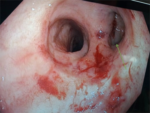 Endoscopic view of the colo-anal anastomosis. The blind-closed portion on the right ( arrow) represents the stapled end of the side-end anastomosis.