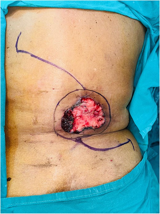Preoperative GBCC of the back measuring 10 × 10 cm lesion with flap marking.