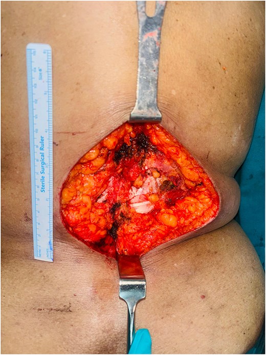 Intraoperative figure showing the defect after tumour excision—defect size 13 × 12 cm.