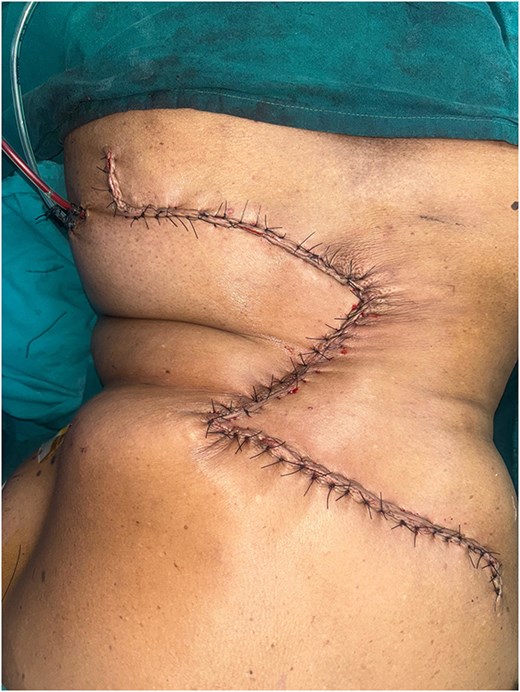 Immediate postoperative result after O-Z flap reconstruction.