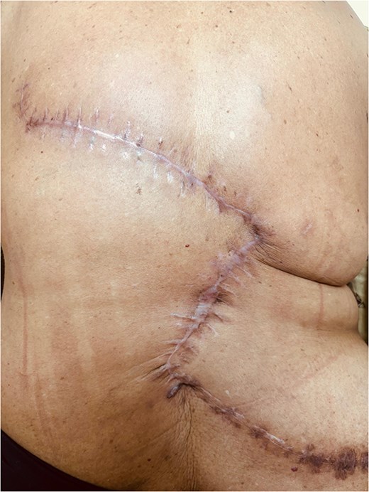 Follow-up picture showing a healthy scar.