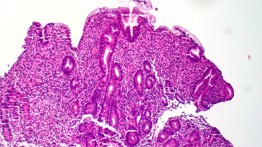 Hematoxylin and eosin (H&E) staining reveals abnormal proliferation of mast cells.
