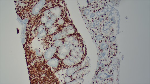 Immunohistochemical staining demonstrates positive expression of CD117.