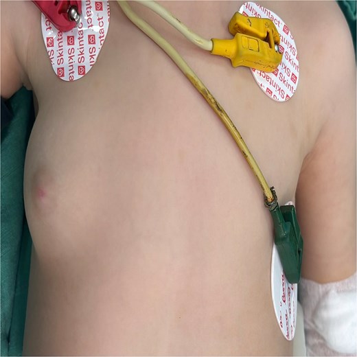 Right breast tumor of a female 2-year-old breastfed infant; tumor growth occurred since the child was 9 months old.