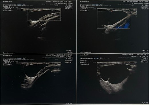 Ultrasonography of left breast showing a cystic lesion.