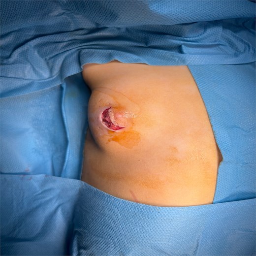 Preoperative image showing the incision.
