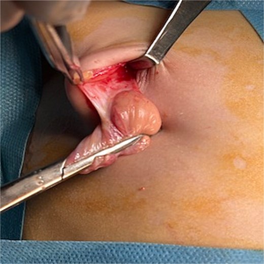 Image of the cyst in preoperative.