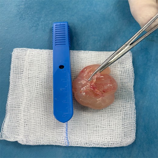 Image showing the resected mass.