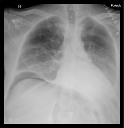A portable chest X-ray with free air under diaphragm.
