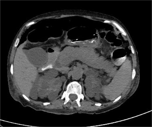 CT scan of abdomen and pelvis: pneumoperitoneum and polycystic disease in the kidneys, liver, and pancreases.