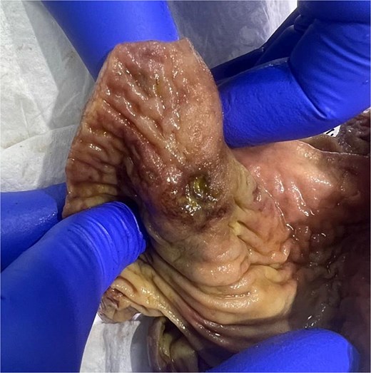 Gross pathology: the cecum shows one perforated ulcer (arrow) and one superficial ulcer.