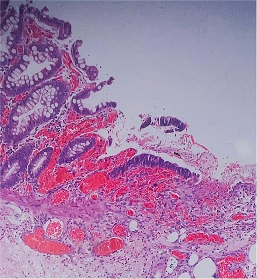 Histopathology: surface ulceration with perforation as indicated by fat lobules (arrow).