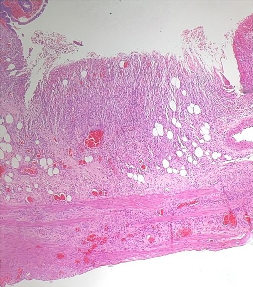 Histopathology: complete surface ulceration with granulation tissue (H&E, × 40).