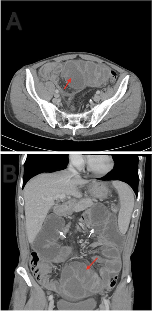 Axial (A) and coronal (B) contrast enhanced abdominal CT. Ileal loops congregated at the pelvis (red arrow). Small bowel loops dilation (white arrow).