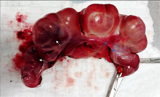 The resected segment of the terminal ilium. Ischemic bowel (white arrows). Thick peritoneum (blue arrows).