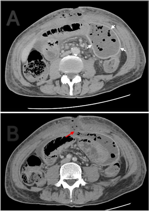 Contrast enhanced abdominal CT. (A) Thick and well localized capsule surrounding the collection (white arrows). (B) The collection is communicating with the atmosphere through a fascial dehiscence (red arrow).