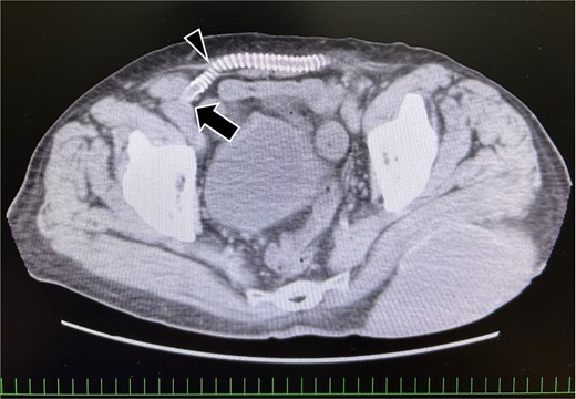 Preoperative computed tomography image showing the vessel graft on the right side. The external iliac artery and artificial vessel graft are anastomosed in the preperitoneal space (arrow). The graft running subcutaneously after originating from the abdominal wall (arrowhead).