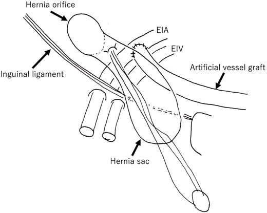 Schematic overview of the case. The orifice is lateral to the artificial vessel graft. The weakness of the posterior wall of the hernial canal was the etiology in this case. The hernial sac is overlaid onto an artificial vessel graft. EIA: External iliac artery; EIV: External iliac vein.