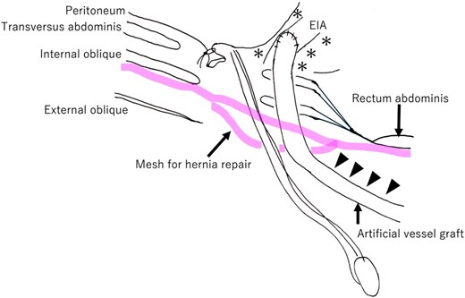 Schematic overview after hernia repair mesh placement. The artificial vessel graft and surrounding tissues were highly adherent. The artificial vessel graft is dissected from the transverse abdominis (arrowhead). The hernia repair mesh is placed between the internal oblique and external oblique muscles over the weak posterior wall of the inguinal canal. In this case, the previous surgical site around both the external iliac artery and artificial vessel graft in the preperitoneal space (*) is left untouched. EIA: External iliac artery.