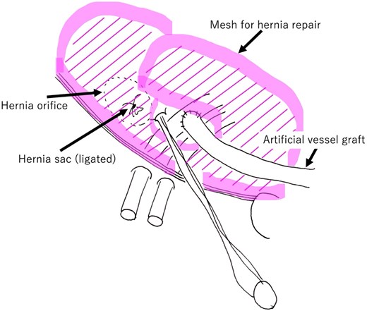 Schematic overview after hernia repair mesh placement. The mesh is placed between the internal oblique muscle and external oblique fascia over the area of the inguinal canal posterior wall.