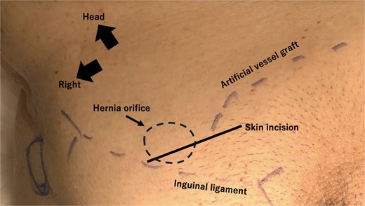 Artificial vessel graft, hernial orifice, and skin incision positions. A skin incision is made over the hernial orifice and the origin of the artificial graft, as confirmed by preoperative ultrasound. The incision is made nearly at the traditional position.