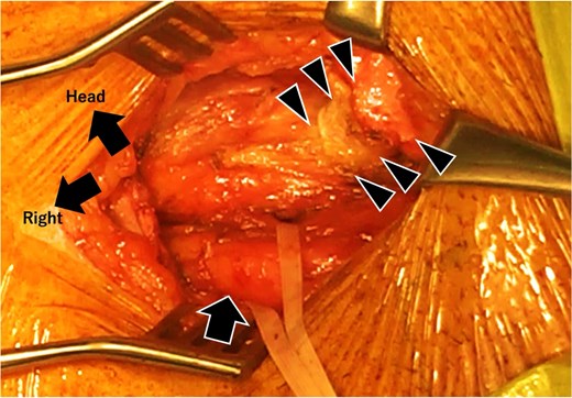 Intraoperative image after artificial vessel graft and spermatic cord dissection. The orifice of the spermatic cord (taped) is lateral to the origin of the artificial vessel graft. The posterior wall of the inguinal canal, located lateral to the artificial vessel graft, is weak and is assumed to be the etiology.