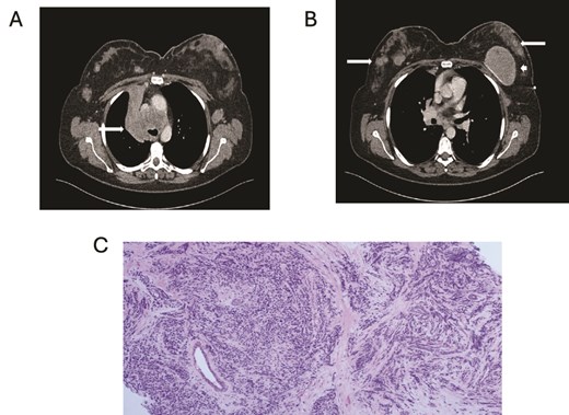 (A) Axial contrast enhanced CT shows right hilar mass. (B) CT scan showing bilateral breast metastasis (arrow) and left breast implant (arrowhead). (C) Cores of breast tissue infiltrated by malignant cells with high nuclear: cytoplasmic ratio, inconspicuous nucleoli and nuclear molding. The appearances are of small cell carcinoma.