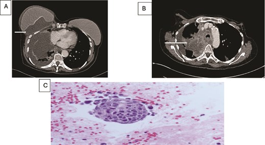 (A) Axial contrast enhanced CT scan shows heterogeneous lung mass with mediastinal invasion. (B) Axial CT image showing peri-implant malignant effusion. (C) fluid around breast implant: groups of atypical cells with hyperchromatic nuclei, high nuclear: cytoplasmic ratio and prominent nucleoli. The appearances are similar to the lung carcinoma diagnosed.