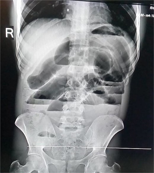 Abdominal X-ray—multiple air fluid levels.